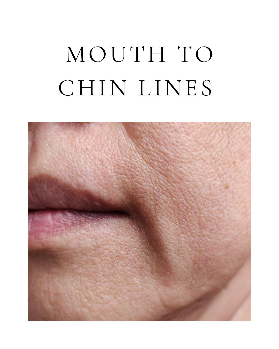 Mouth to Chin Lines